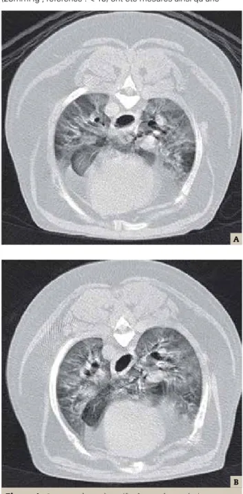 Figure 4  : Scanner thoracique (fenêtre pulmonaire)  obtenu après sédation au moment du diagnostic  (A) et après 4 mois de suivi (B) montrant  une atteinte généralisée du parenchyme  pulmonaire (opacités en verre dépoli, 