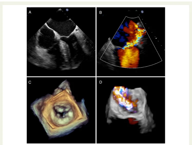 Figure 1 Three-dimensional transoesophageal echocardiographic evaluation of the mitral valve