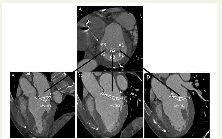 Figure 2 Contrast-enhanced ECG-gated cardiac computed tomographic evaluation of the mitral valve