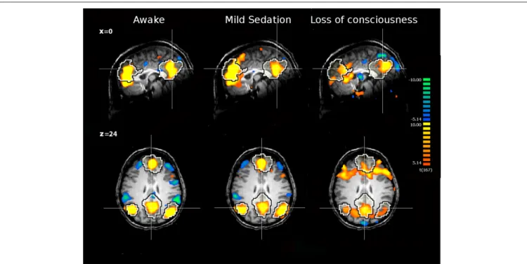 FIguRE 1 | The internal network of a healthy subject awake, under mild  sedation and after loss of consciousness
