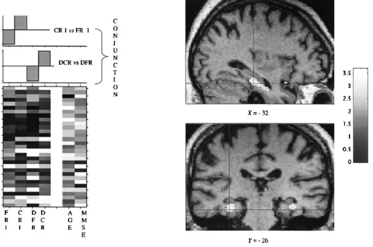 TABLE 2. Correlations between brain metabolism and free versus cued recall in AD patients