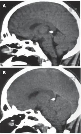 Figure 1  Computed tomography (CT) (sagittal sections) of the brain of a 17-year  old man who developed fulminant hepatic failure
