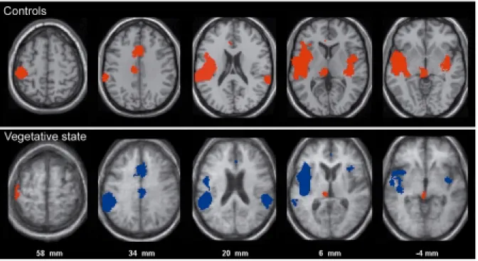 Figure 5. Pain perception in VS. (Upper) Brain regions, shown in red, that activated during  noxious stimulation in controls [subtraction stimulation-rest] (Lower) Brain regions that  activated during stimulation in VS patients, shown in red [subtraction s