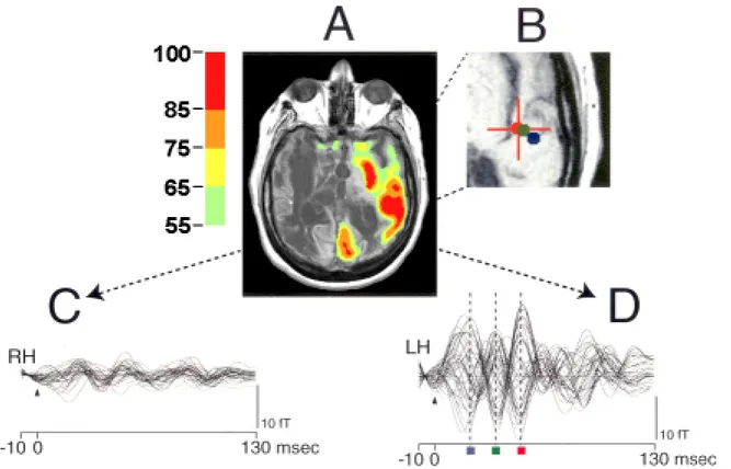 Figure 6. A. Preservation of regional cerebral metabolic activity in a chronic VS patient
