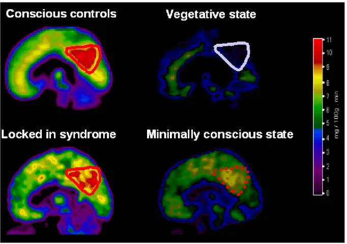 Figure 7. Illustration of resting cerebral metabolism obtained in control subjects and patients  in a vegetative state, locked-in syndrome and minimally conscious state