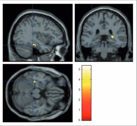 Figure 2. Regions with higher functional connectivity with the left precuneus in patients with medication-overuse headache (MOH) when compared to healthy controls (HCs)