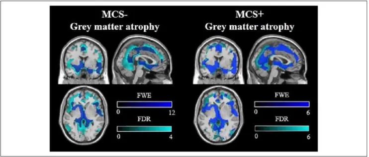 Figure 3. Brain structure results using voxel-based morphometry. Comparison of gray matter structure volume  between patients in MCS- and healthy subjects and between patients in MCS+ and healthy subjects