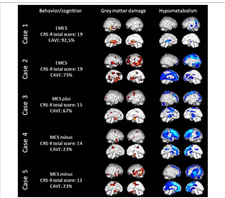 FIGURE 1 | Behavioral and cognitive data, loss of gray matter volume (in red) as assessed with MRI voxel-based morphometry and cerebral hypometabolism (in blue) as assessed with FDG-PET in all five patients