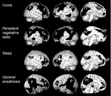 Figure  1.  Metabolic  activity  in  four  types  of  unconsciousness,  subtracted  from  conscious  controls