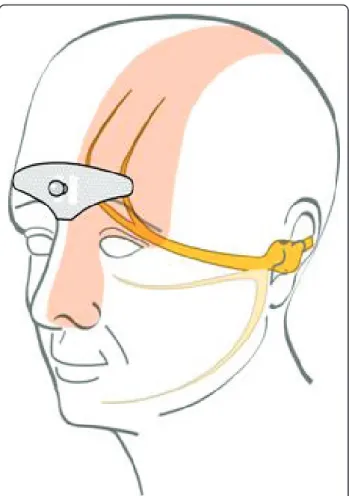 Figure 1 The stimulation electrode placed on the forehead covers the supratrochlear and supraorbital nerves.