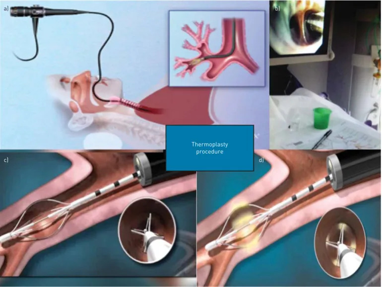 FIGURE 1 Bronchial thermoplasty procedure. a) Bronchial thermoplasty is performed through fibreoptic bronchoscopy