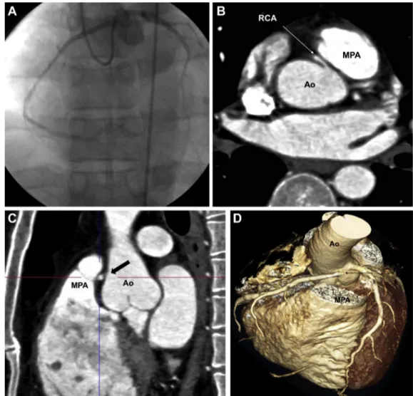 Figure 2. Operative ﬁ ndings. Black arrow indicates the anomalous right coronary artery from the left coronary sinus