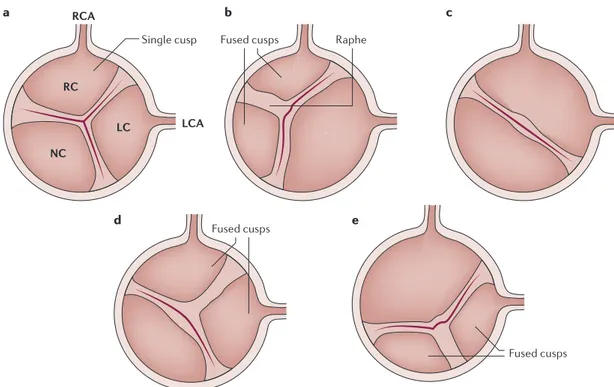Figure 2 | Comparison of tricuspid and bicuspid aortic valve structures. Schematic representation of a normal —  tricuspid — aortic valve with the three cusps (part a), a bicuspid valve with right non-coronary cusp fusion and one raphe  (the line of union 