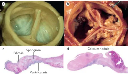 Figure 3 | Macroscopic and histopathological appearance of normal and abnormal  aortic valves