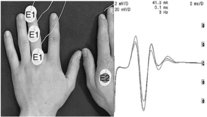 FIGURE 1. Three monopolar recordings (superimposed curves) with increasing distance between the ulnar stimulation site at the wrist and the active recording electrode E1 placed over digit 3 (E2 contralateral)