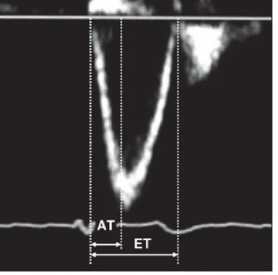 Fig. 1: Normal Doppler flow pattern of pulmonary artery to demonstrate measurement of  acceleration time (AT) and ejection time (ET)