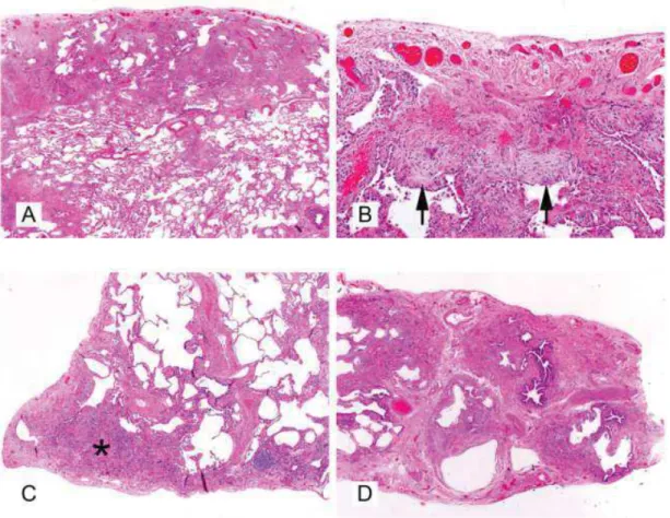 Fig. 19: Histopathological UIP pattern characteristics of IPF include (A) a subpleural  distribution of fibrosis (20x, H&amp;E), (B) fibroblastic foci (arrows) with a relative absence of  inflammatory cell infiltrate (400x, H&amp;E), (C) smooth muscle prol