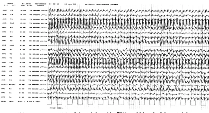 Figure 4 : Exemple d’EEG d’une absence enregistrée dans le cas d’une JME {2}.