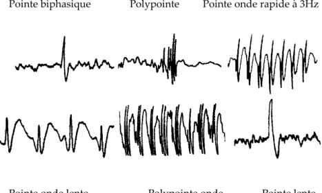 Figure 3: Tracé EEG d’un patient atteint de JME A. en intercritique {5} B. lors d’une crise myoclonique {3}.