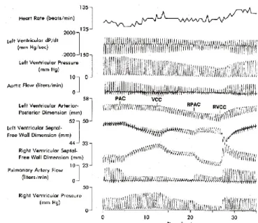 Figure 9: Change in stroke volume and PV diagram for a  change in thoracic pressure 