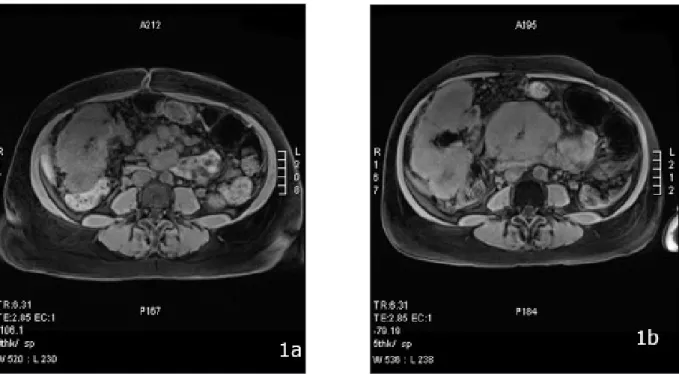 Figure 1. Comparaison entre l’IRM de départ et le contrôle post-3 cures de chimiothérapie, objectivant la progression néoplasique.