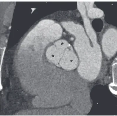 Fig. 3. – Coronal contrast-enhanced CT image demonstrating  a premature degenerated bicuspid valve in a 36-year-old woman  with extensive valve calcifications and thickened cusps