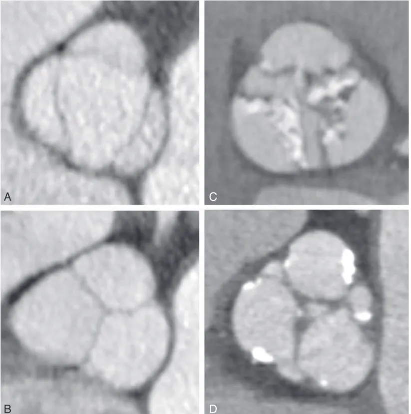 Fig. 6. – Evaluation of aortic valve stenosis and insufficiency using CT. Panel A illustrates the normal opening of the valve during  systole