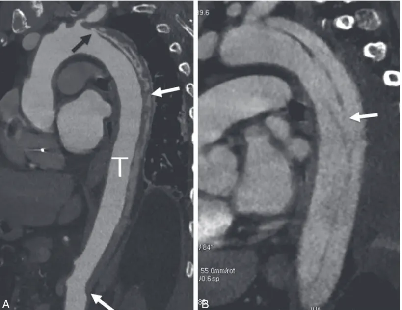 Fig. 7. – Evolution from an intramural hematoma to a classic dissection in a 32-year-old man with acute chest pain