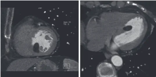 Fig. 2. — Systolic (A) and diastolic (B) image of an artificial mitral valve that shows absence of proper opening of the posterior  leaflet.