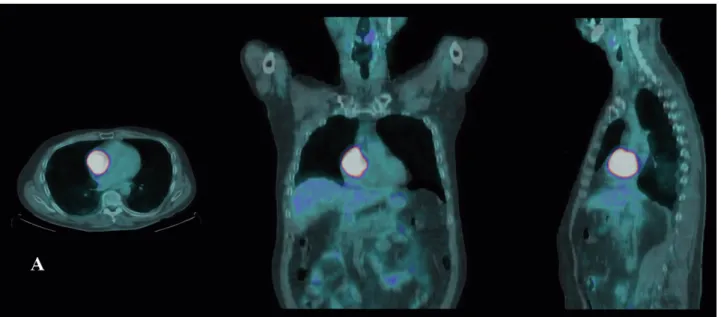 Figure 1 A, B. PET-CT-scan (coupe frontale, sagittale et transversale) mon- mon-trant une hyperfixation de fluoro-désoxy-glucose (18-FDG) dans la tumeur  intra-auriculaire droite, correspondant à un hypermétabolisme focal au sein  de cette métastase cardia