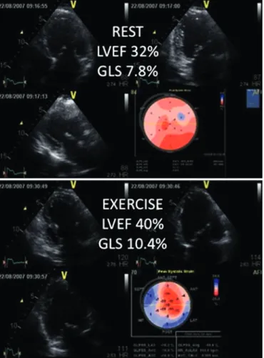 Table 1 Exercise echocardiographic assessment before cardiac resynchronisation therapy implantation