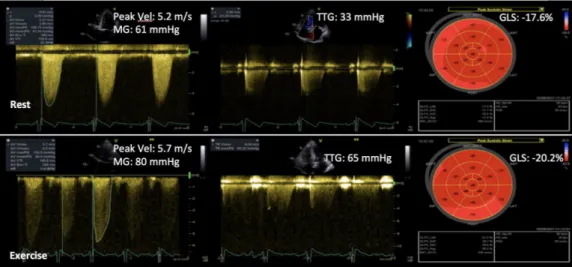 Figure 4  Exercise stress echocardiography in an asymptomatic patient with degenerative mitral regurgitation