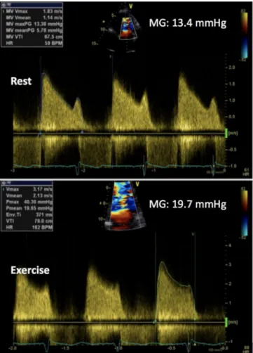 Figure 5  Exercise stress echocardiography in an asymptomatic patient  with mitral stenosis and significant increase in mean mitral pressure  gradient (MG).