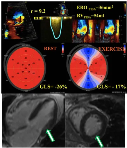 Figure 3. Moderate primary mitral regurgitation  with normal left ventricular longitudinal function but  without contractile reserve