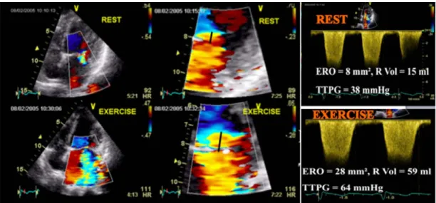 Figure 5. Exercise echocardiographic  recordings (end-systolic frames) showing  a biphasic response (viable myocardium  at jeopardy) characterized by an  improve-ment in wall motion at low level of exercise  followed by a subsequent deterioration at  high 