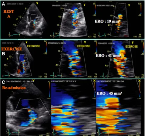 Figure 8. A and B, Dynamic exercise mitral  regurgitation in a patient admitted with  acute pulmonary edema without evident  contributing factors