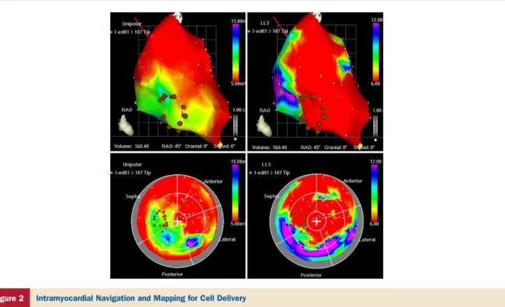 Figure 2 Intramyocardial Navigation and Mapping for Cell Delivery