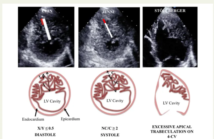 Figure 1 Echocardiographic criteria for left ventricular non-compaction.