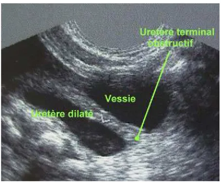 Fig. 7 : Mégauretère primitif obstructif congénital (aspect en échographie) 