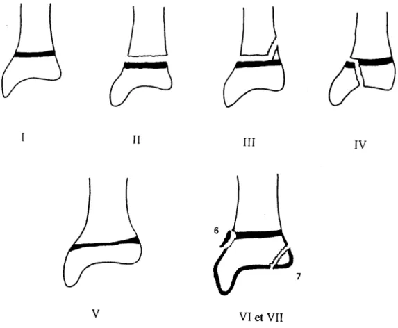 Figure 2 : Différents types de fractures épiphyso-métaphysaires selon Salter-Harris  et Ogden 