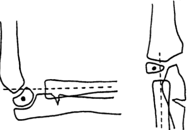 Figure 5 : Fracture cubitale avec luxation de la tête radiale: l'axe radial ne coupe  plus le centre du noyau condylien