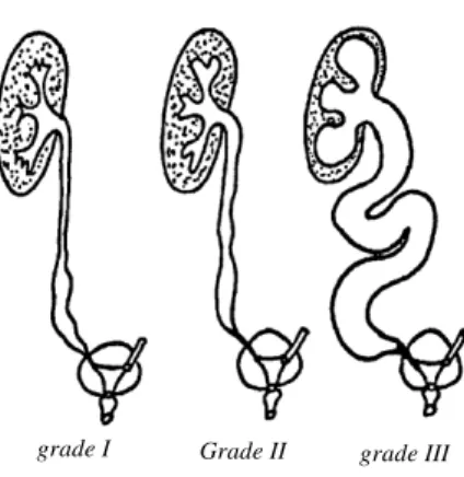 Figure 6 : Différents types de méga-uretères. 