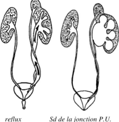 Figure 9 : Pathologie de reflux et syndrome de jonction. 