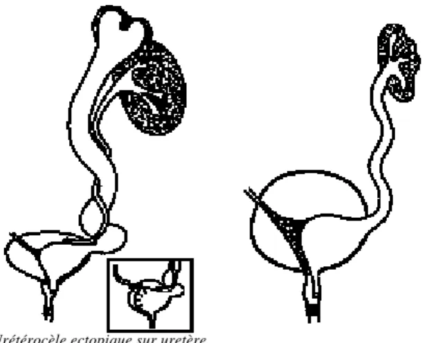 Figure 11 : Urétérocèles ectopiques. 