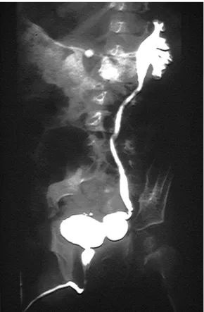 Figure 1 : Diverticule para-urétéral de HUTCH avec reflux vésico-urétéral gauche de grade II 