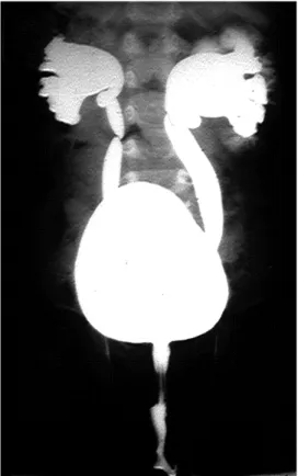 Figure  2  :  Reflux  vésico-urétéral  bilatéral  de  grade  IV  avec  reflux  intraparenchymateux  rénal  bien  visible  à  gauche