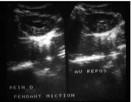 Figure  9  :  Reflux  vésico-urétéral  suspecté  lors  de  l'échographie  au  repos  et  en  cours  de  miction (élargissement transitoire du bassinet)