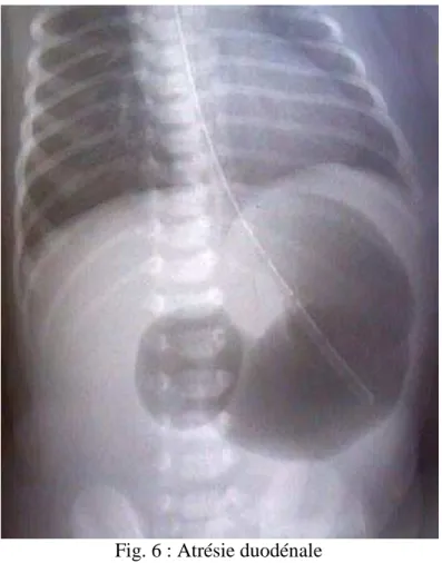 Fig. 6 : Atrésie duodénale  ASP : Image en double bulle 