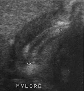 Figure 2 : échographie d'une sténose du pylore.  