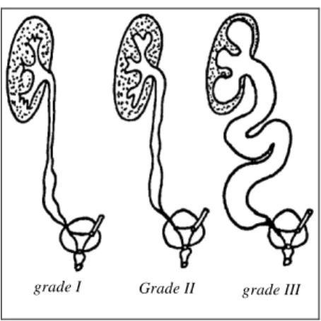 Figure 6 : Différents types de méga-uretères. 